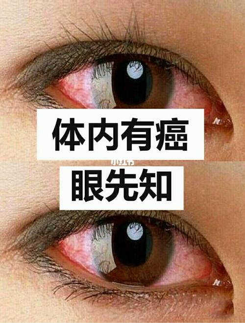 体内有癌眼睛先知?提醒:眼睛出现5异常当心或是癌症光降 人工智能 体内有癌眼睛先知?提醒:眼睛出现5异常当心或是癌症光降 体内有癌眼睛先知?提醒:眼睛出现5异常当心或是癌症光降 人工智能