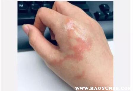低温烫伤!暖宝宝可达到50-60℃并不算很高为何仍常烫伤人? 智能家居 低温烫伤!暖宝宝可达到50-60℃并不算很高为何仍常烫伤人? 低温烫伤!暖宝宝可达到50-60℃并不算很高为何仍常烫伤人? 智能家居