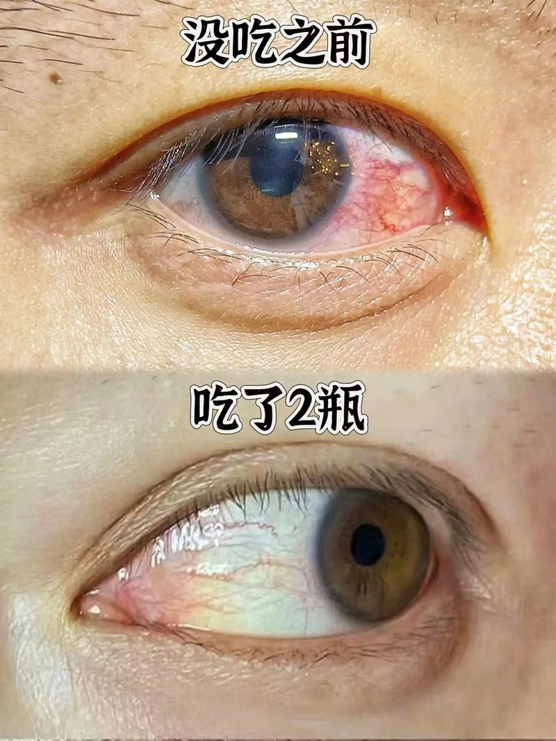 宅家运用电子产品过度 麦粒肿、视疲乏症状“找上门” 智能家居 宅家运用电子产品过度 麦粒肿、视疲乏症状“找上门” 宅家运用电子产品过度 麦粒肿、视疲乏症状“找上门” 智能家居
