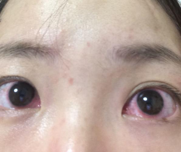 戴“隐形”睡觉 损伤眼角膜 戴“隐形”睡觉 损伤眼角膜 智能科技